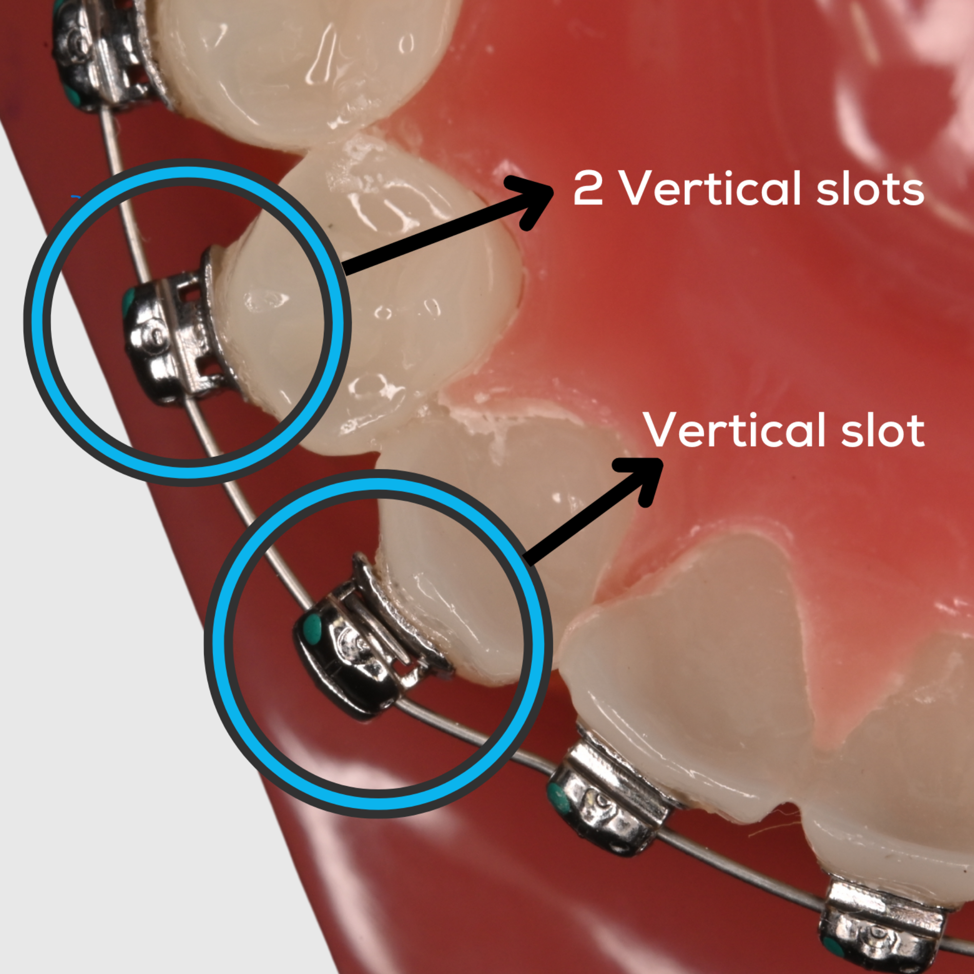 teSLa Pebble Passive SL Bracket (7-7 Kit with One patient wire set