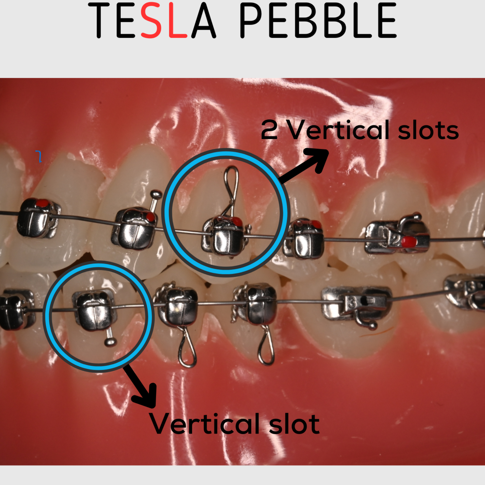 teSLa Pebble Passive SL Bracket (7-7 Kit with One patient wire set